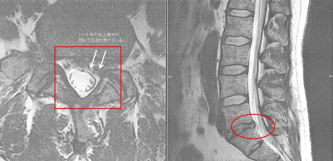 腰椎椎間板ヘルニア(4番、5番)